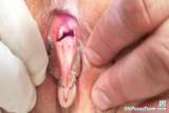 Gyno doctor speculum examines very old mature pussy